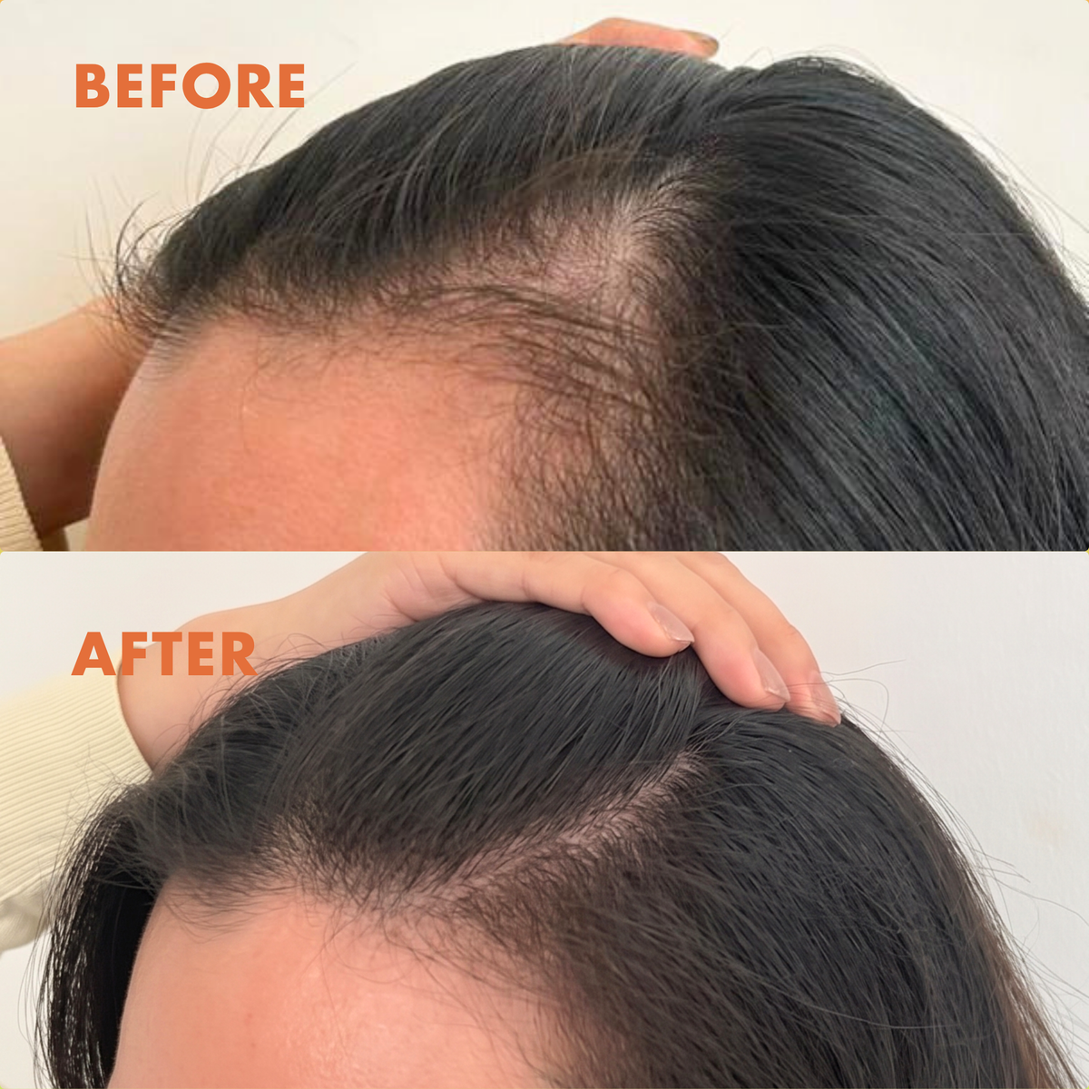 Stressed-Out Hair: Why Stress Makes You Shed — and How to Look After Your Scalp